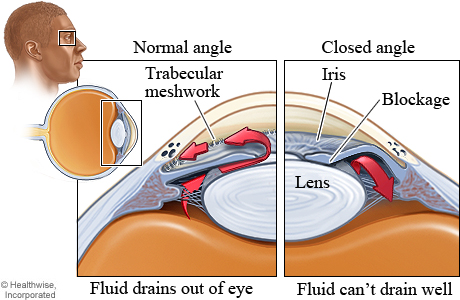Angle Closure Glaucoma