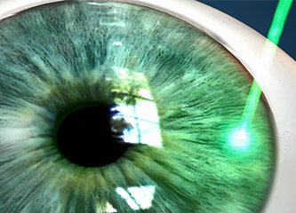 Angle Closure Glaucoma