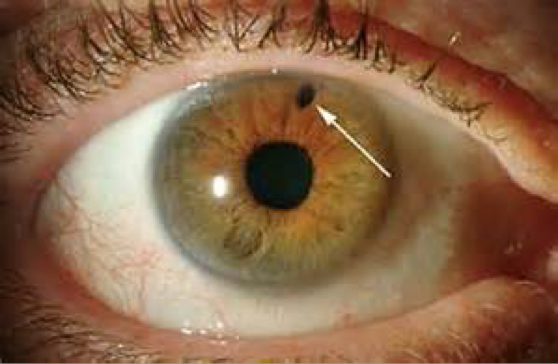 Angle Closure Glaucoma
