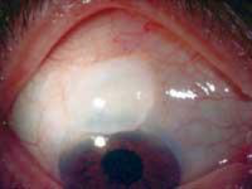 Angle Closure Glaucoma