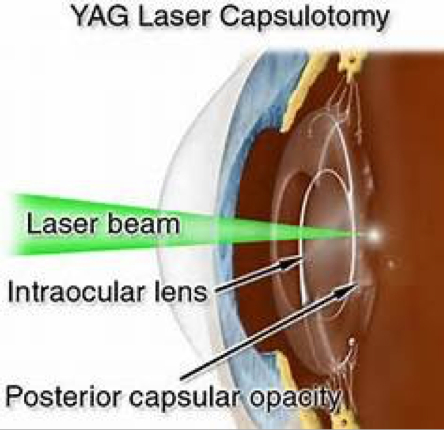 yag laser